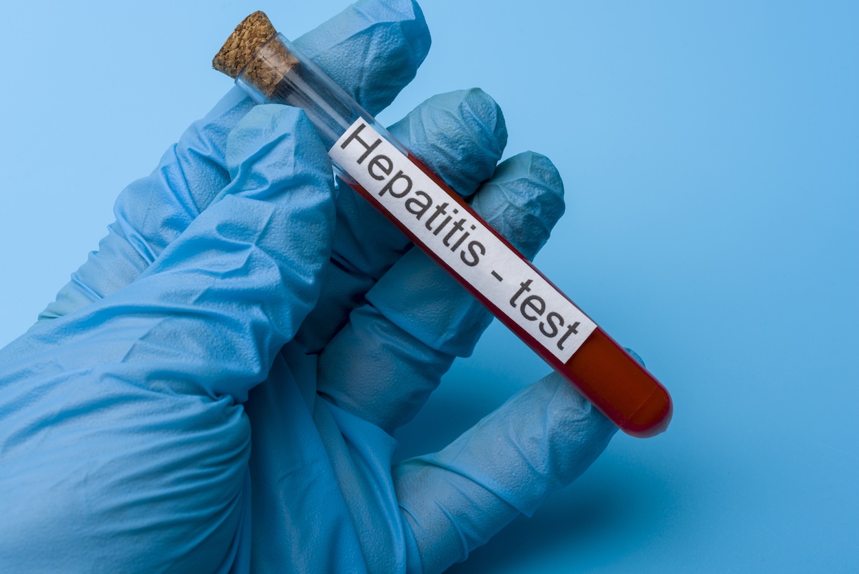 Hepatitis test, Blood in the test Tube. The concept of Medicine and Analysis.